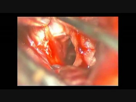 Aneurisma cerebral (aneurisma de la arteria comunicante anterior): clipado