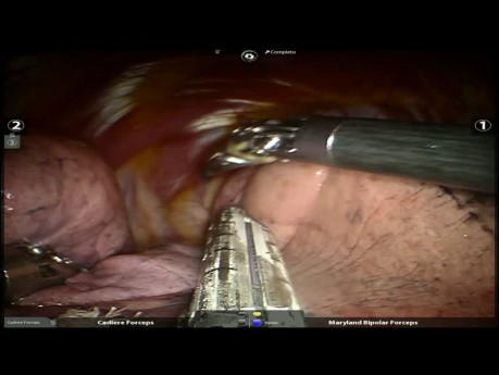 Lobectomía inferior derecha con broncoplastia