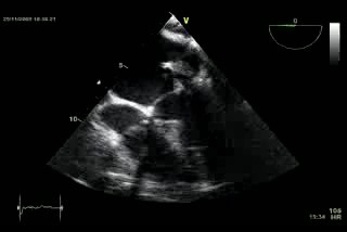 Enorme vegetación mitral: endocarditis infecciosa