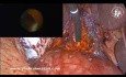 Exploración laparoscópica del conducto biliar común (CBC) después de una CPRE fallida con cierre primario del CBC