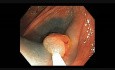 Colonoscopia - cómo realizar RME - lesión C 