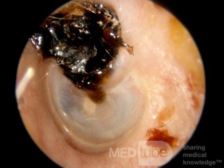 Colesteatoma oculto por la corteza del ático