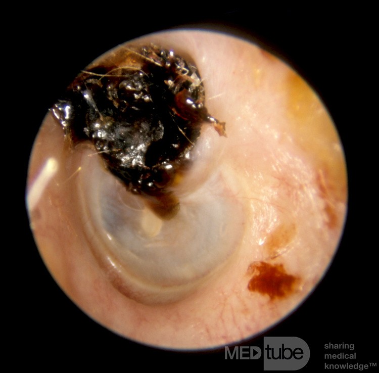 Colesteatoma oculto por la corteza del ático