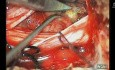 Tumor espinal extramedular intradura cola de caballo