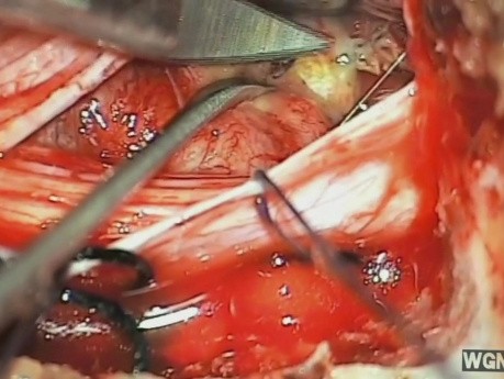 Tumor espinal extramedular intradura cola de caballo