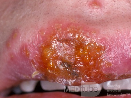Herpes simple temprano en el labio superior [Vista más cercana]