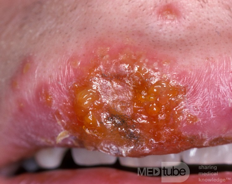 Herpes simple temprano en el labio superior [Vista más cercana]