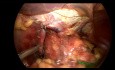 Fundoplicación de Toupet con colocación de malla hiatal 