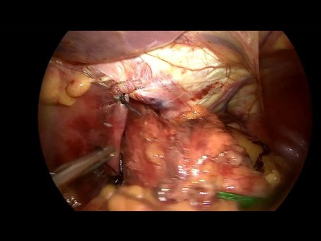 Fundoplicación de Toupet con colocación de malla hiatal 