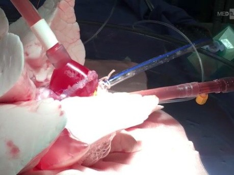 Perfusión pulmonar ex vivo con uso de 10 grados centígrados en lugar de la temperatura clásica