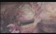 Miomectomía laparoscópica de un mioma uterino de la pared anterior