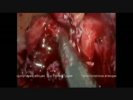 Apendicectomía laparoscópica para apendicitis gangrenosa