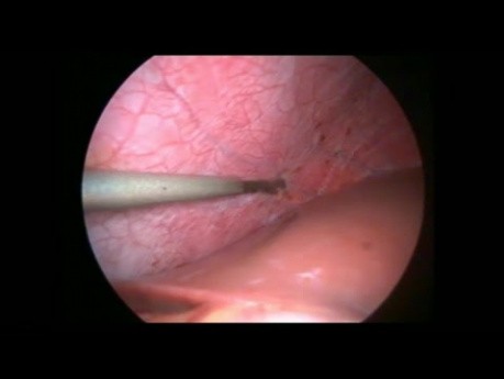Laparoscopia para la endometriosis diafragmática
