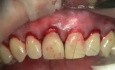 Mejora de la estética del periodonto marginal en el área de la antigua corona protésica