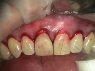 Mejora de la estética del periodonto marginal en el área de la antigua corona protésica