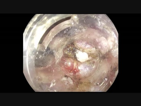 DSE difícil - adenoma rectal recurrente