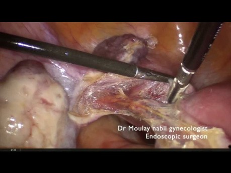 Histerectomía supracervical laparoscópica de 15 minutos