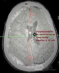 Hemorragia Subdural Aguda Espontánea en el Espacio Subdural