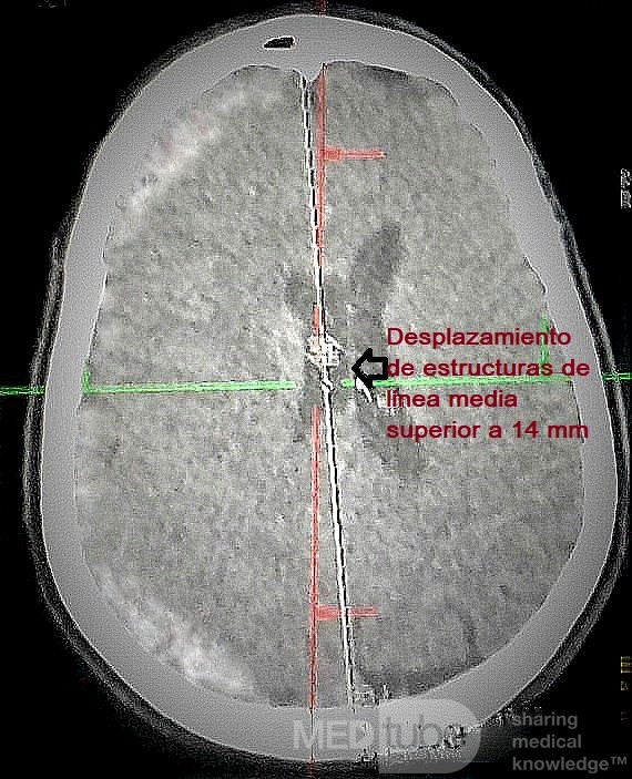 Hemorragia Subdural Aguda Espontánea en el Espacio Subdural