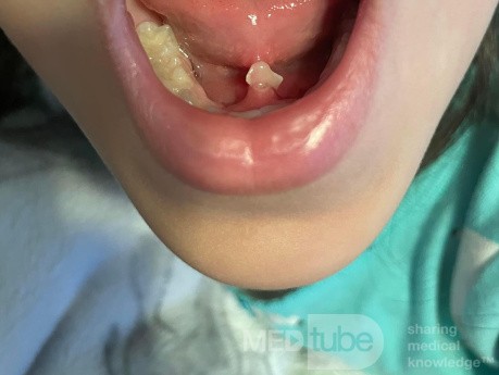 Piedra de la glándula submandibular en un niño