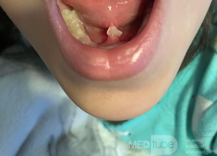 Piedra de la glándula submandibular en un niño