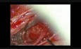 Meningioma espinal: extirpación microquirúrgica