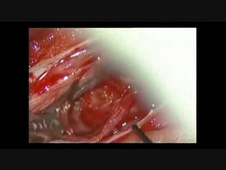 Meningioma espinal: extirpación microquirúrgica