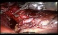 Tumor carcinoide del lóbulo inferior derecho