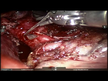 Tumor carcinoide del lóbulo inferior derecho