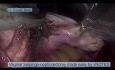 La salpingo-ooforectomía vaginal facilitada por vNOTES