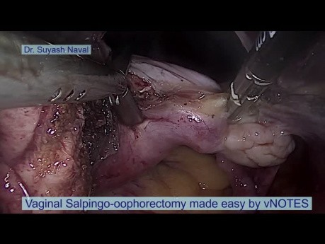 La salpingo-ooforectomía vaginal facilitada por vNOTES