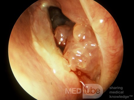 Papiloma invertido del seno esfenoidal