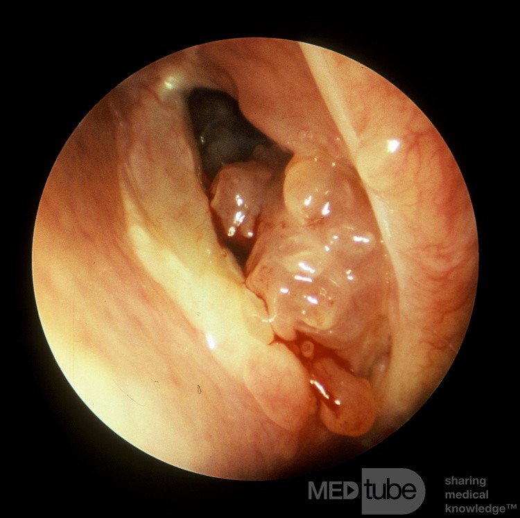 Papiloma invertido del seno esfenoidal