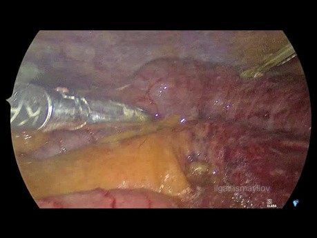 Manejo mínimamente invasivo de la hernia transomental estrangulada