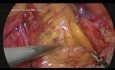 Reparación laparoscópica de hernia inguinal