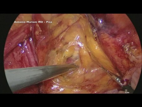 Reparación laparoscópica de hernia inguinal