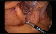 Resección transversal laparoscópica de colon por el cáncer