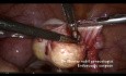 Cistectomía estándar para quiste dermoide ovárico