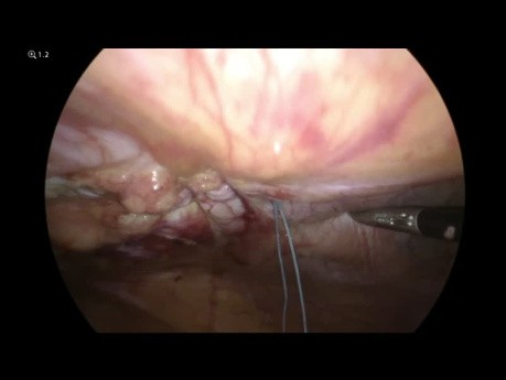 Hernia en el sitio del puerto (con intestino delgado estrangulado)