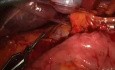 Manejo laparoscópico del sangrado durante la resección anatómica del hígado