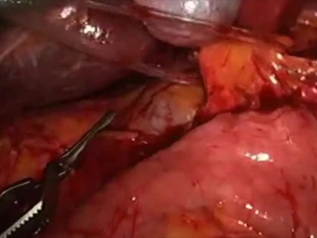 Manejo laparoscópico del sangrado durante la resección anatómica del hígado