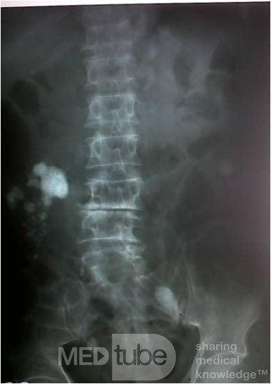 Nefrolitiasis derecha