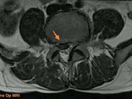 Cirugía de Columna Endoscópica Unilateral Biportal