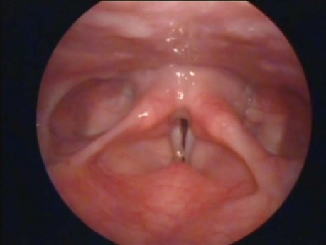 Nódulos en las cuerdas vocales