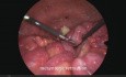 Laparoscopia para el diagnóstico de malignidad intraperitoneal, aplicación de la puntuación de Fagotti