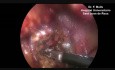 Necrosectomía laparoscópica en pancreatitis necrosante aguda