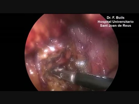 Necrosectomía laparoscópica en pancreatitis necrosante aguda