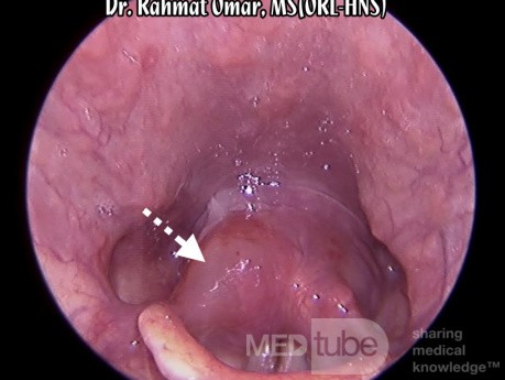 Angioedema alérgico del aritenoides