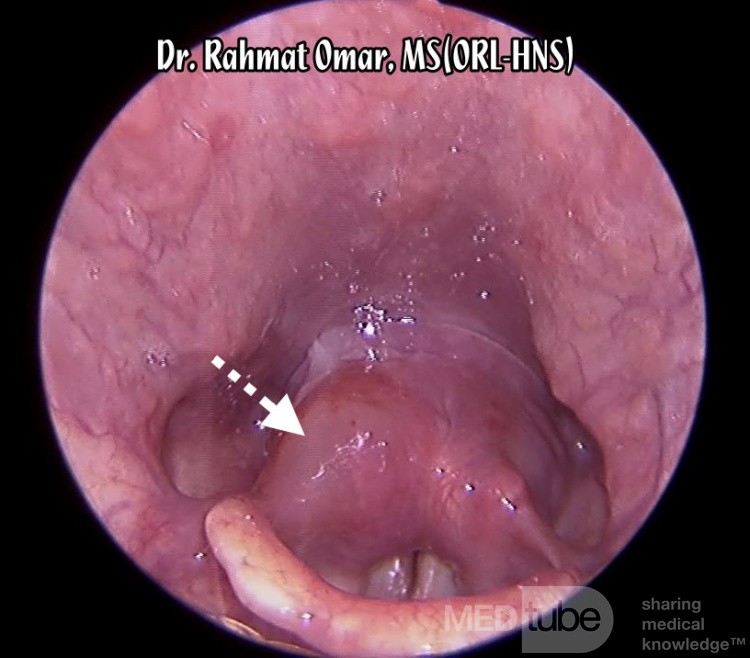 Angioedema alérgico del aritenoides