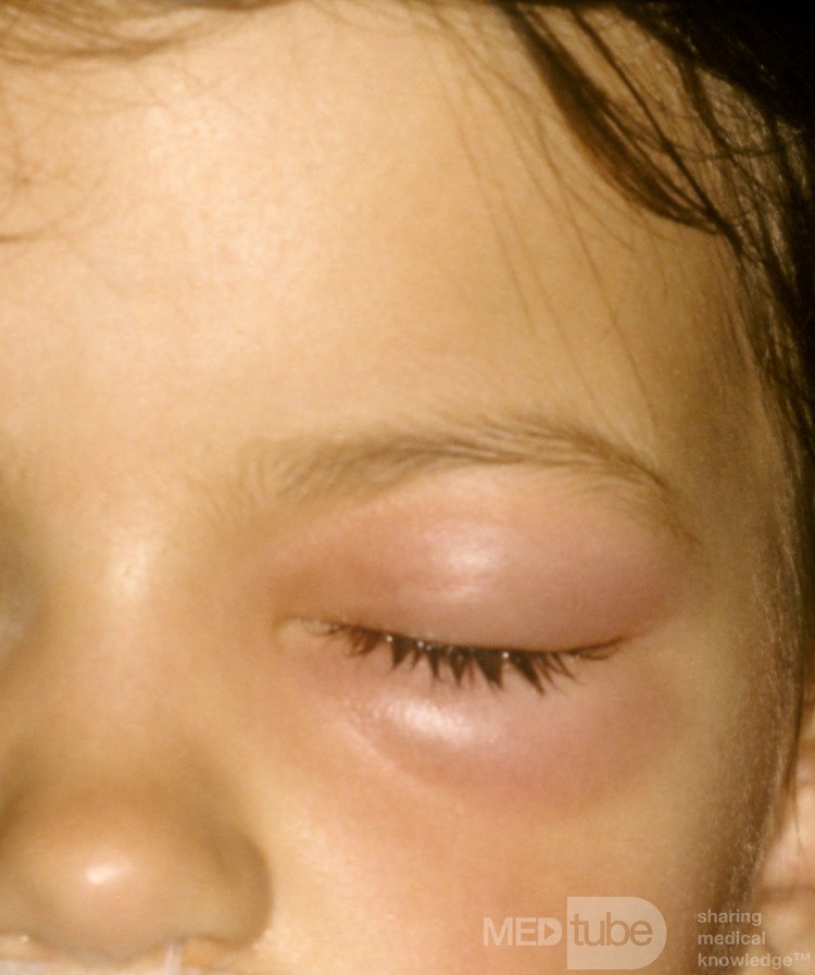 Celulitis orbitaria secundaria a pansinusitis aguda 1